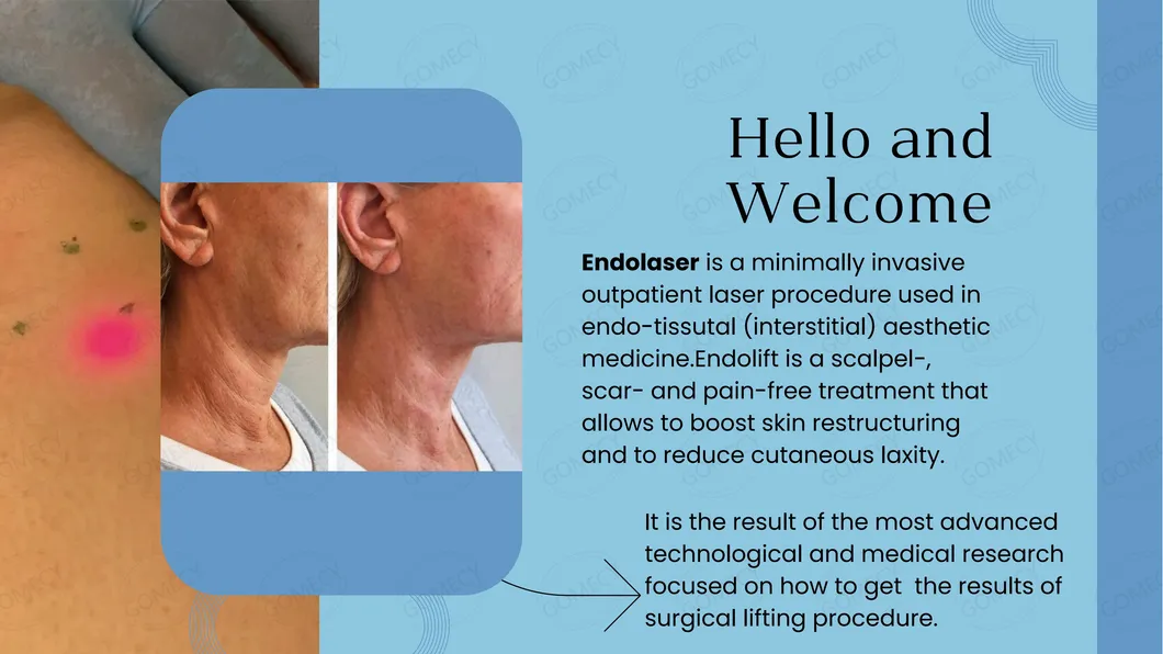 Endolaser Treatment