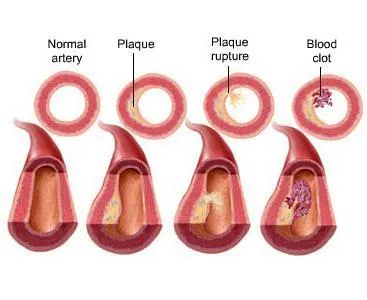 Central Arterial Pressure Analysis