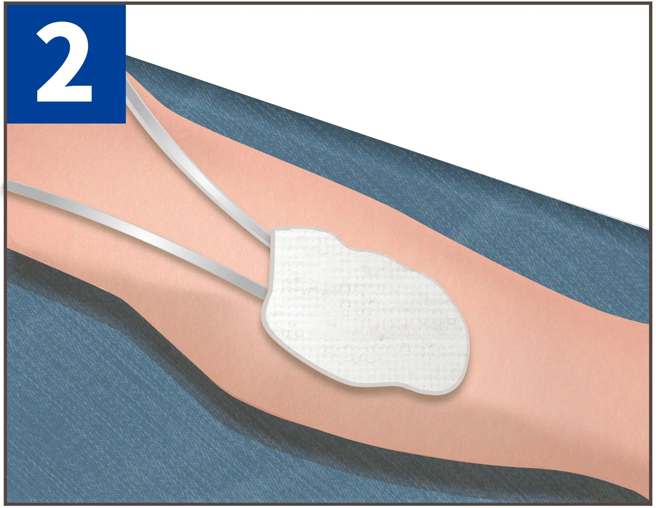 Wholesale Medical Use Disposable Negative Pressure Wound Therapy Dressing for Venous Insufficiency Ulcers