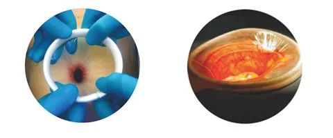 Incision Protector View 1