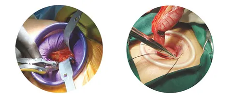 Incision Protector View 2