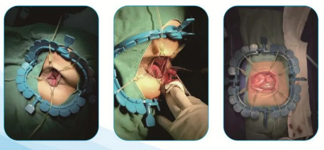 Surgical Application 2