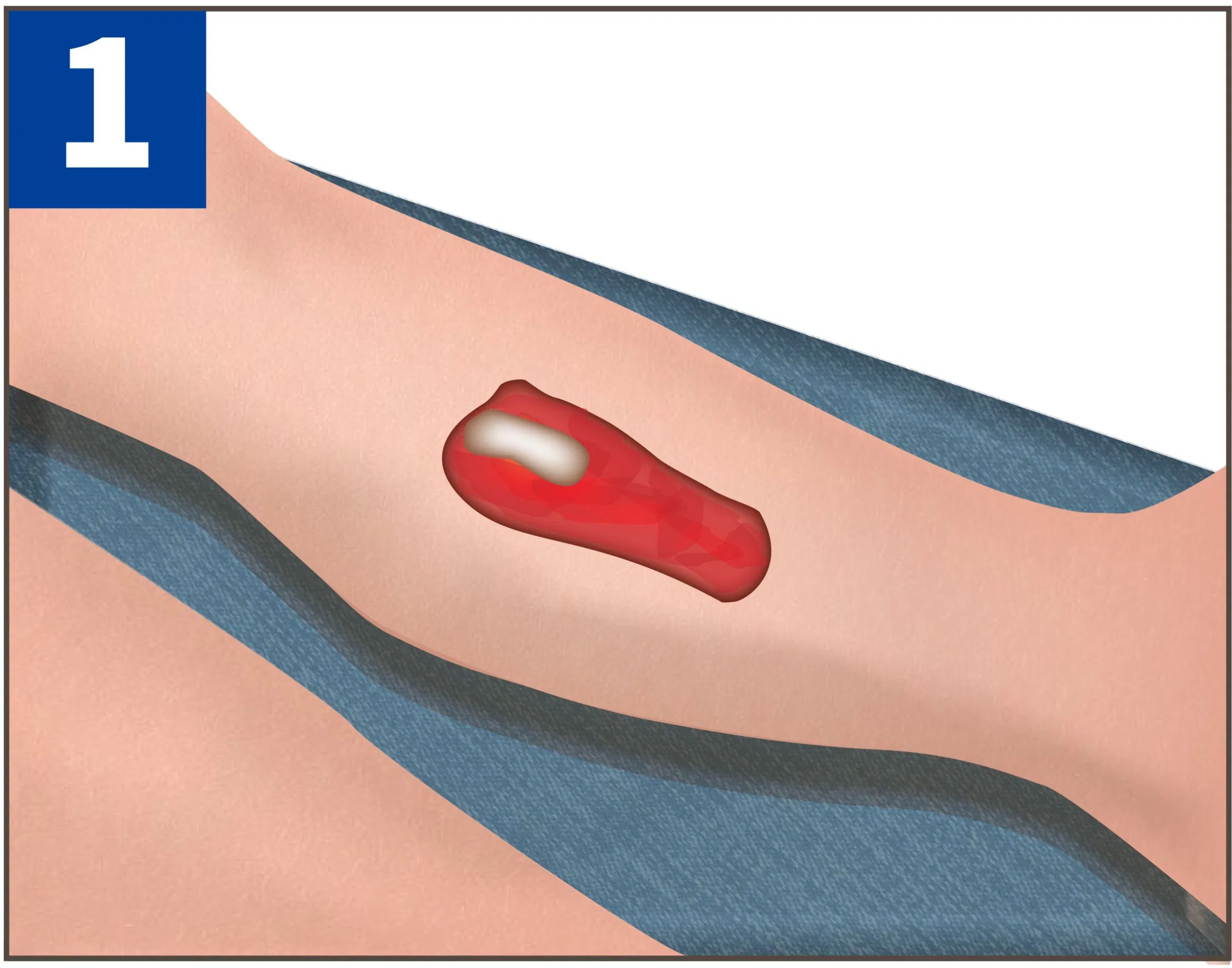 Wholesale Medical Use Disposable Negative Pressure Wound Therapy Dressing for Venous Insufficiency Ulcers