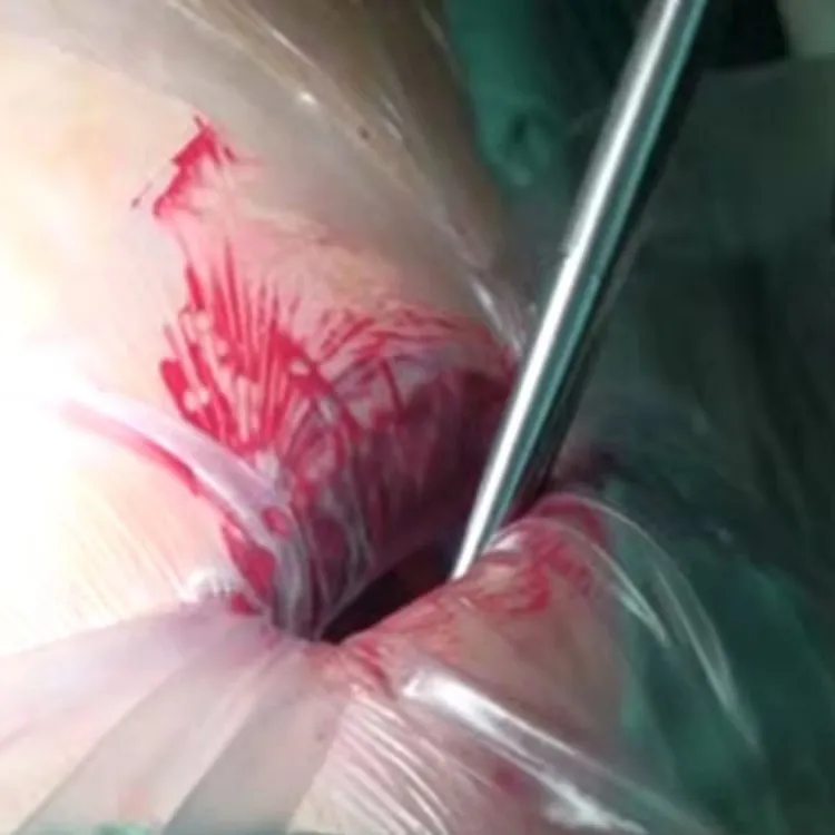 Wound Protector Detail 1