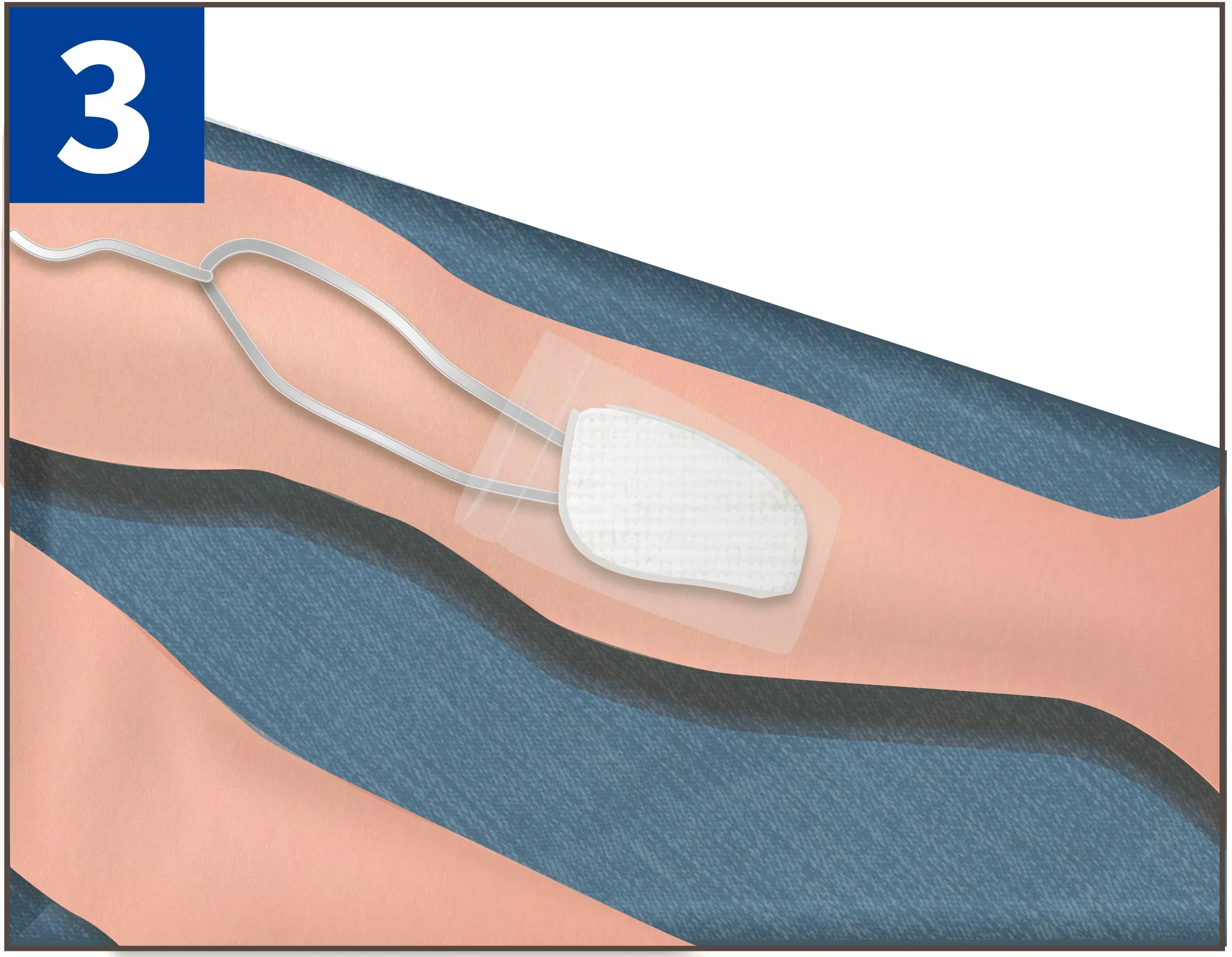 Wholesale Medical Use Disposable Negative Pressure Wound Therapy Dressing for Venous Insufficiency Ulcers