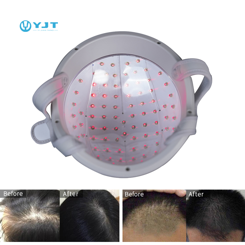 FDA 510K Revolutionary 650nm Lllt Photobiomodulation Hair Loss Treatment 82 Diode Laser Helmet Hair Growth Cap
