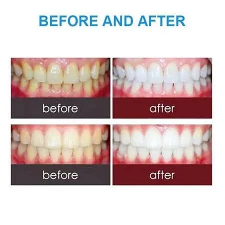 Dental Flash Light 3