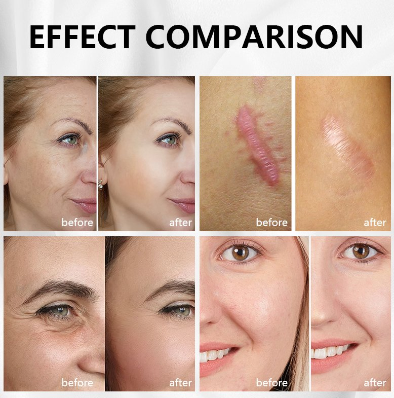 2025 Beauty Equipment Factory Price Facial Skin Care Lifting Rejuvenation Hifu Laser Hair Removal RF Microneedling Machine
