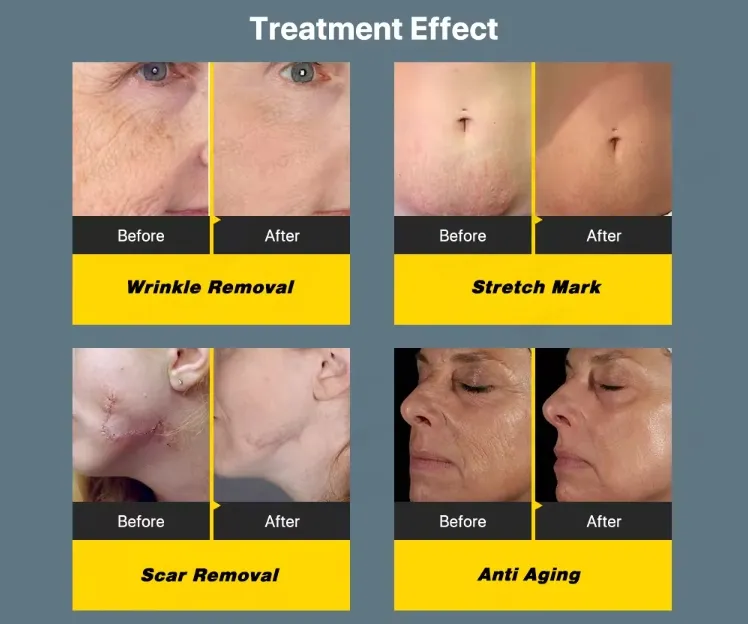 Micro Needle Skin Care System Micro Needling RF Fractional Facial Gold RF Microneedling Machine