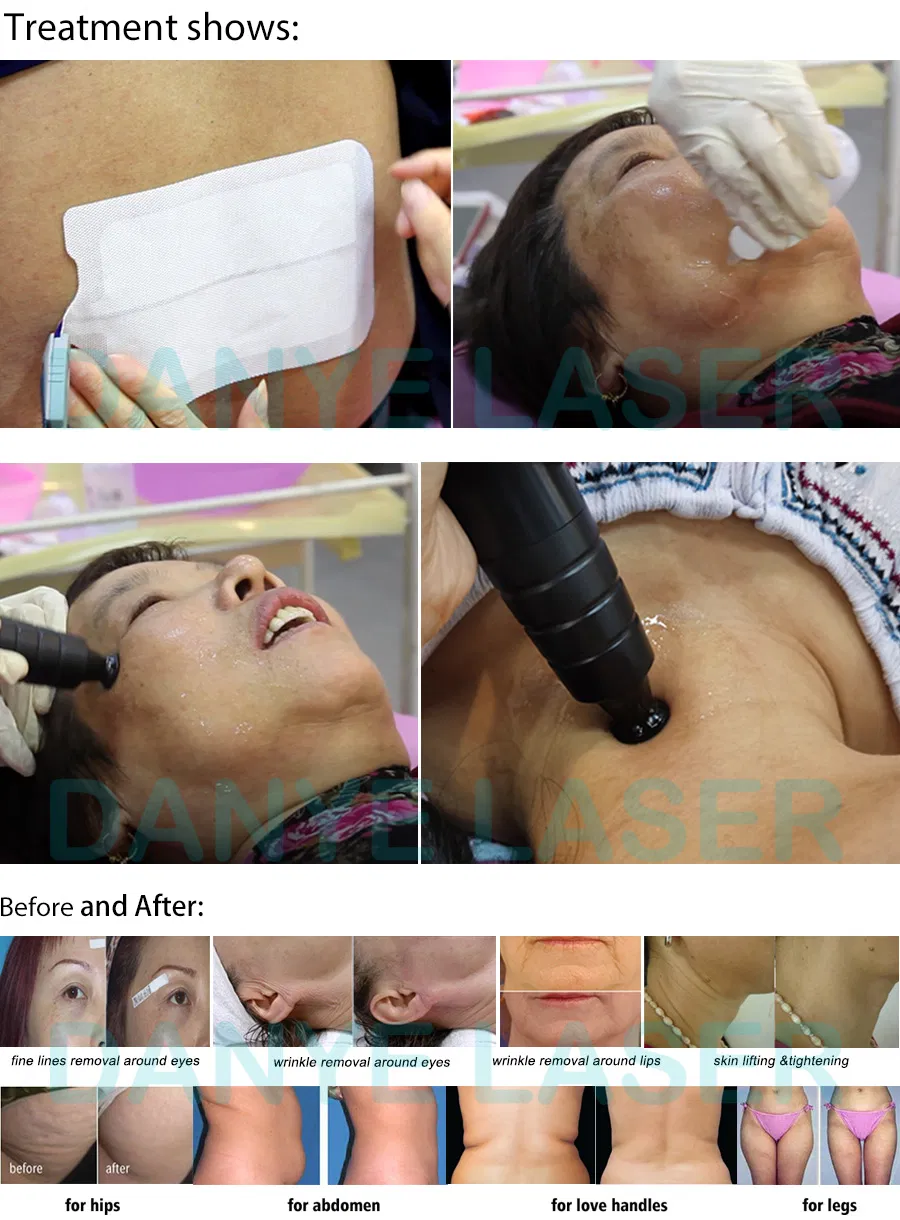 RF Thermal Radiofrequency Facial Skin Rejuvenation Wrinkle Removal Beauty Machine