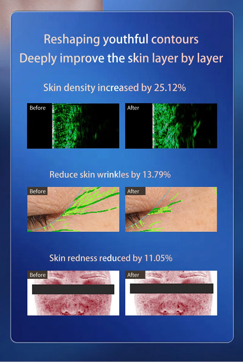 Gold RF-Hifu Microneedle 3-in-1 Facial Treatment Machine
