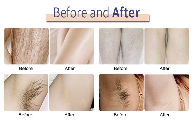 Hair Removal Comparison Results