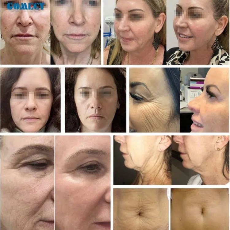 RF Face Lifting Machine Radio Frequency Microneedling Fractional RF Facial Device