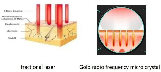 Gold RF-Hifu Microneedle 3-in-1 Facial Treatment Machine