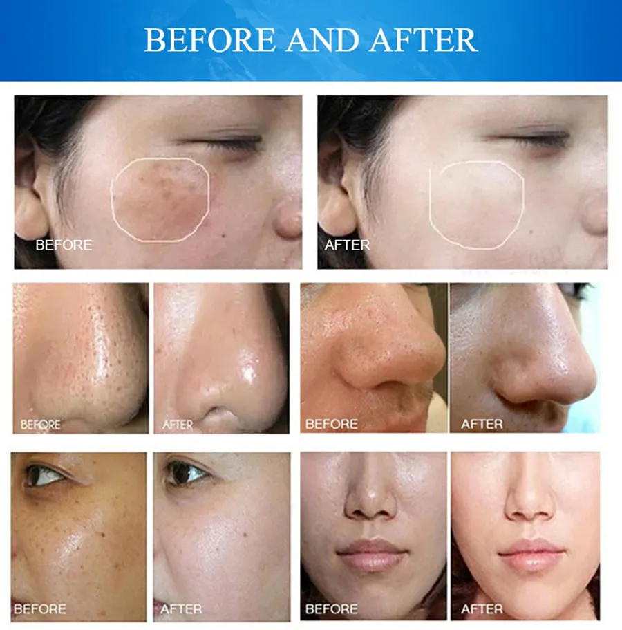 Multifunction Facial Care Machine for Deep Cleansing, RF Lifting, Wrinkle Removal, and Skin Exfoliation
