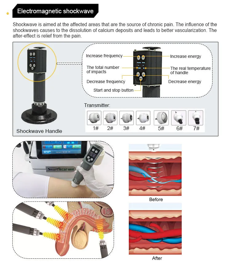 Deep Acoustic Shockwave Technology and Body Contouring Application