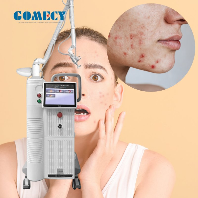 Gomecy High Quality Fractional CO2 RF Laser Machine Fractional CO2 Laser for Acne Scars Removal Machine