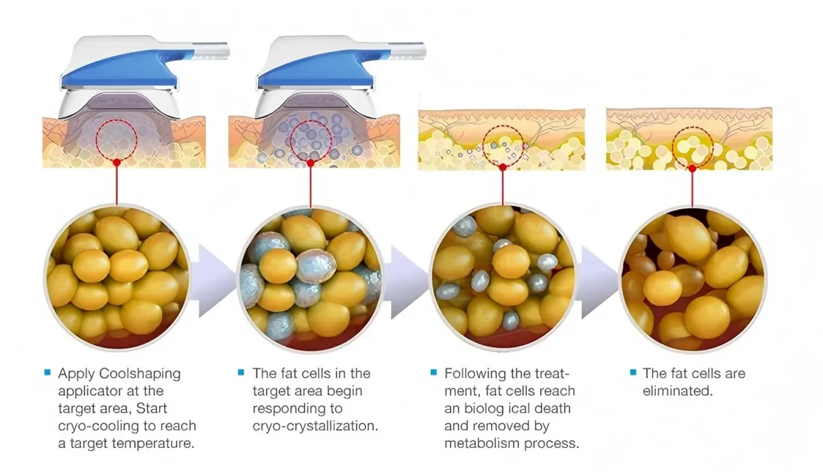 Cryo Angle Technology