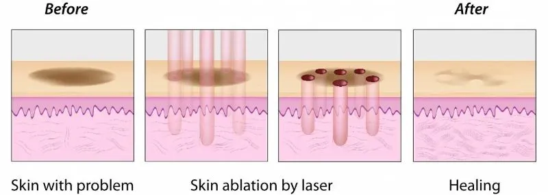 Mechanism of Action