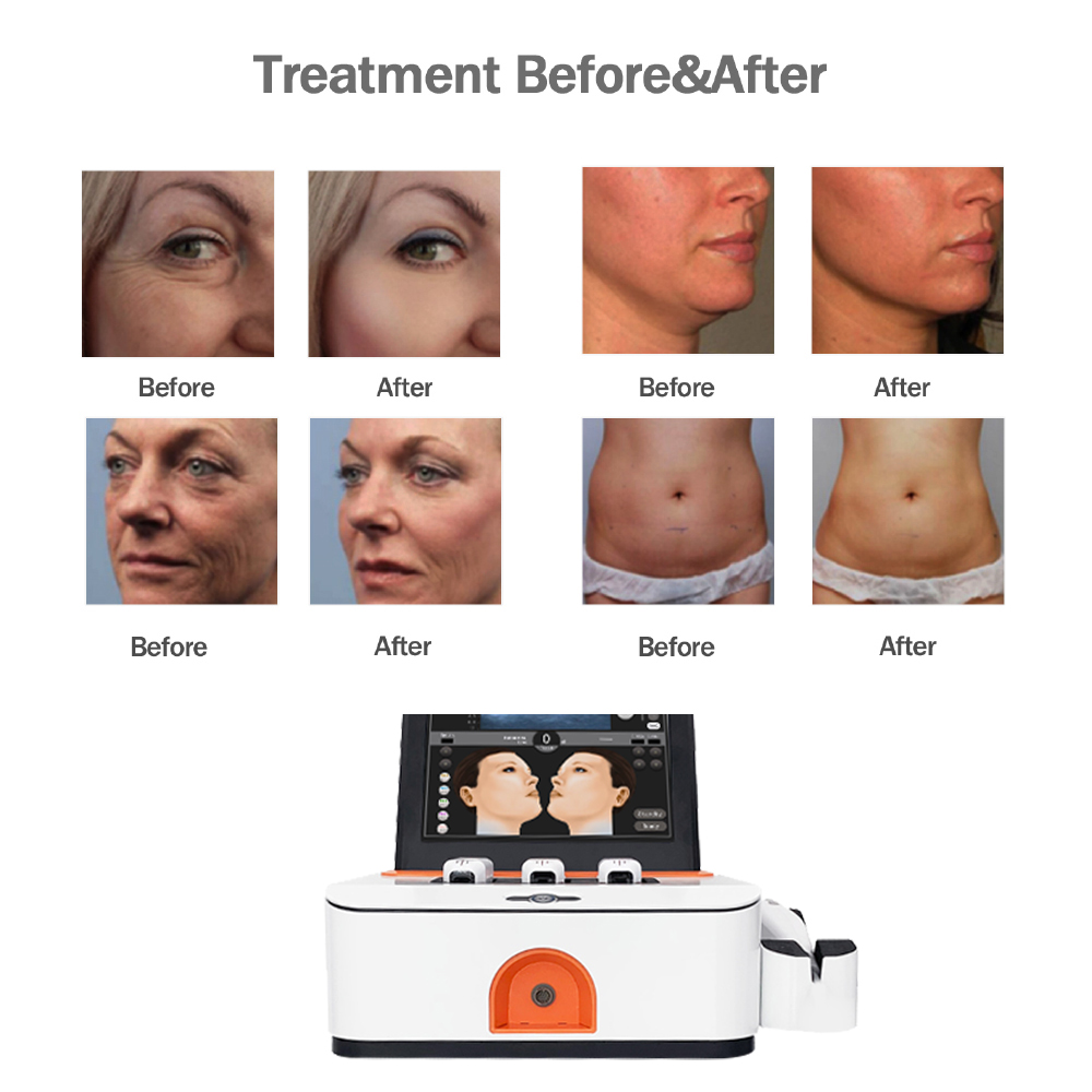 High Intensity Focused Ultrasound hifu machine face lifting Anti Wrinkle Beauty Machine for Collagen Regeneration