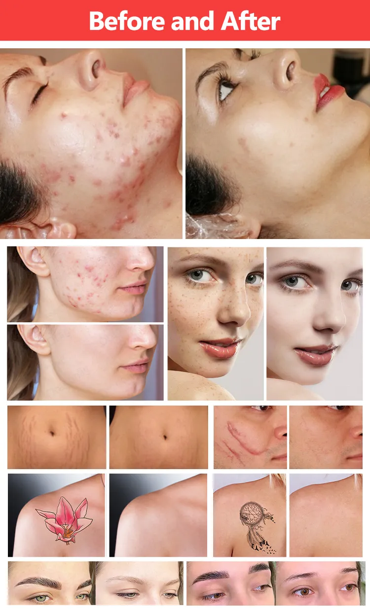 2 in 1 Multifunction ND YAG Laser Before and After Tattoo Removal Results