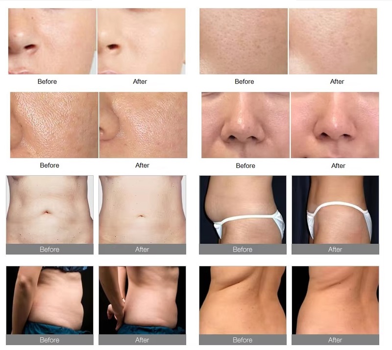 Dual Technology HIFU Skin Tightening System for Face Neck Lifting with Energy Lines and Cooling Protection
