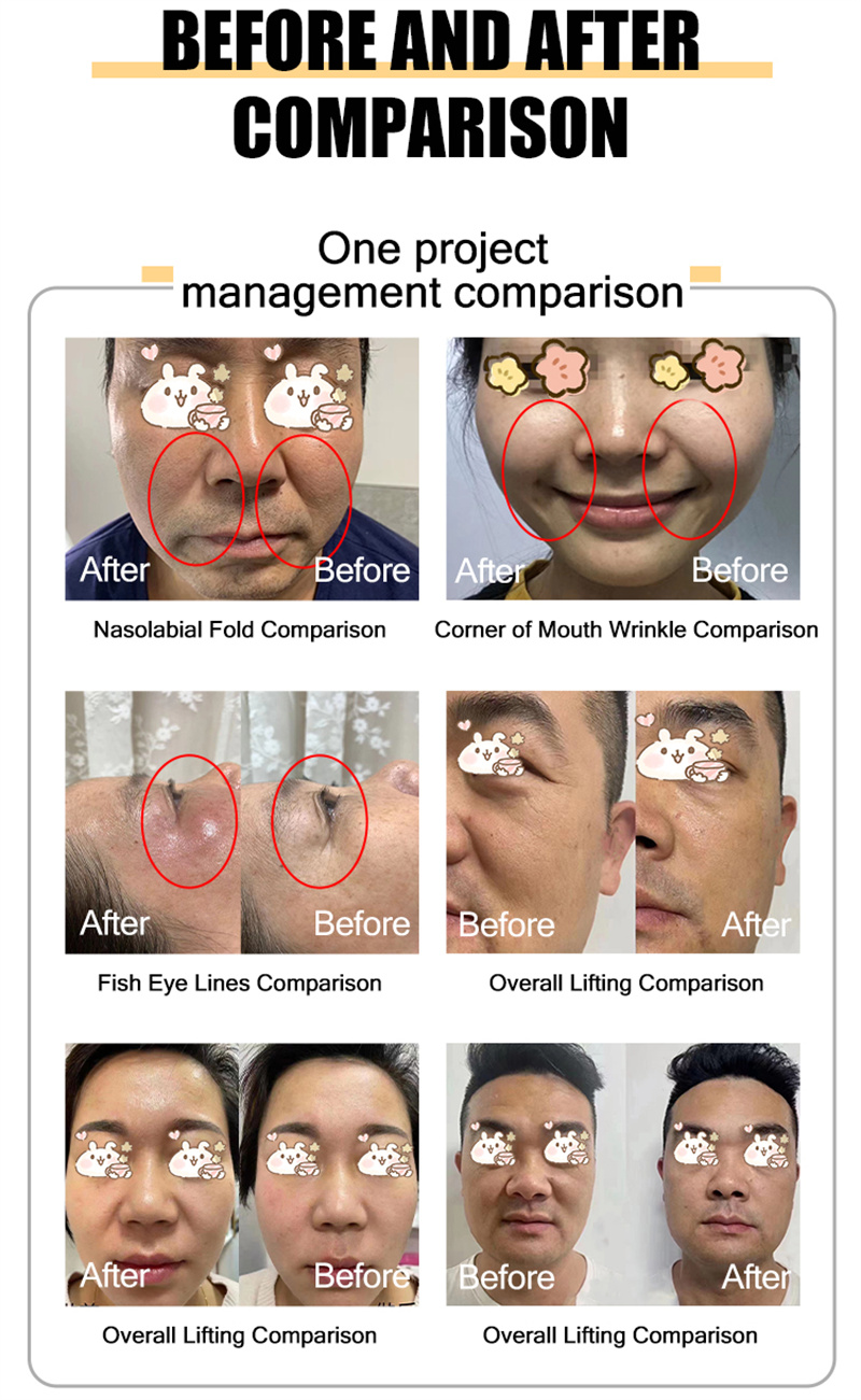 7D Hifu Machine Face Lift
