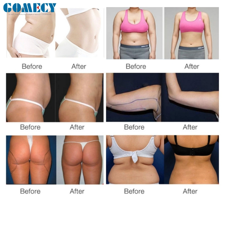 360degree Inner Ball Roller Therapy Endo Lymphatic Drainage Cellulite Removal Face Lift Body Muscle Massage S Shape Slim Machine
