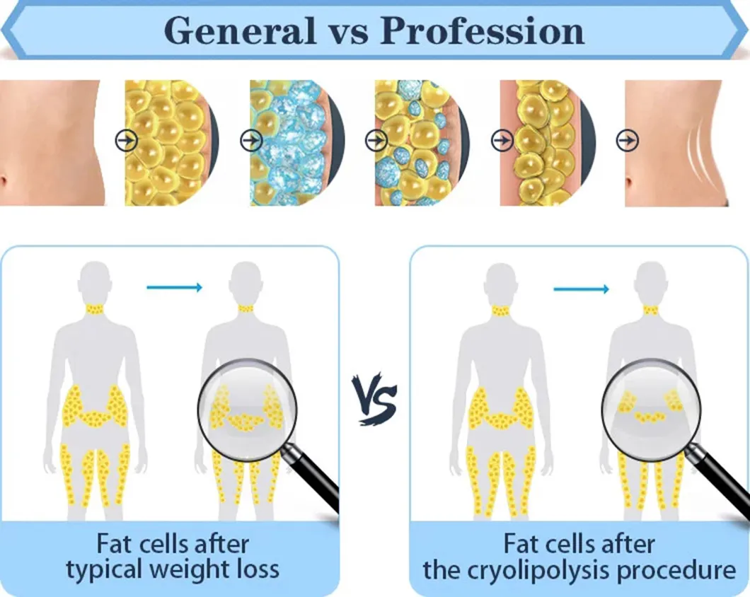 Ce Approved Beauty Machine Slimming Cool Shape Fat Freezing Slim Cryolipolysis Weight Loss Machine