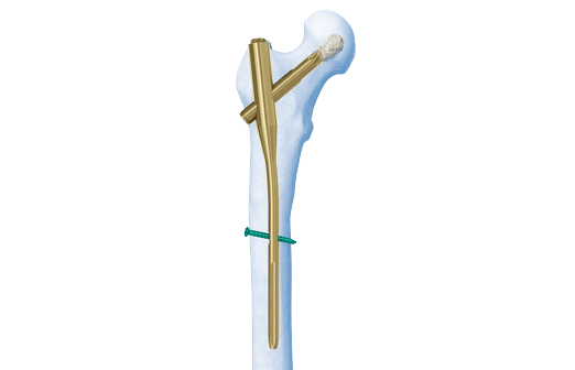 PFNA Interlocking Nail Specifications