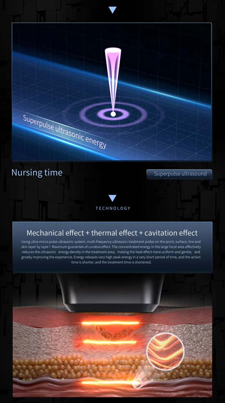 12D MAX HIFU Detail 6
