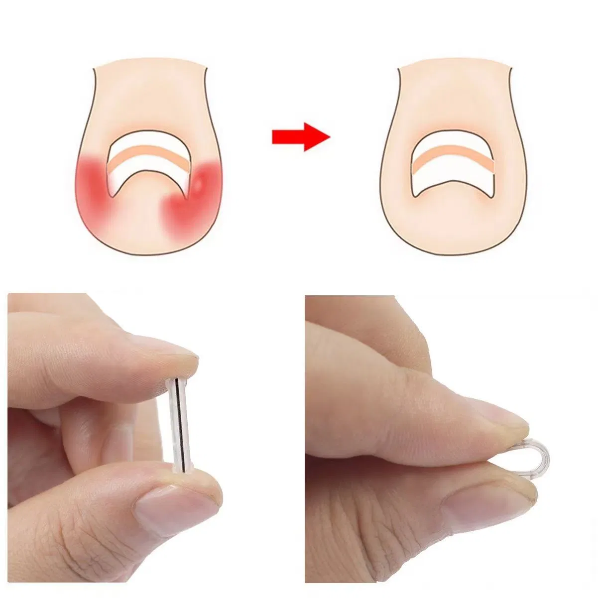Professional Home Care for Curved Nails Waterproof, Nail Tools and Ingrown Toenail Removal Kit, Ingrown Toenail at Home