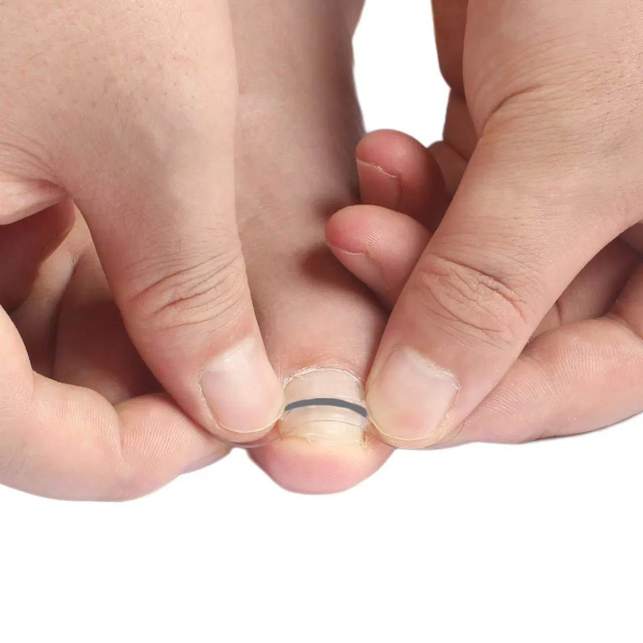 Professional Home Care for Curved Nails Waterproof, Nail Tools and Ingrown Toenail Removal Kit, Ingrown Toenail at Home