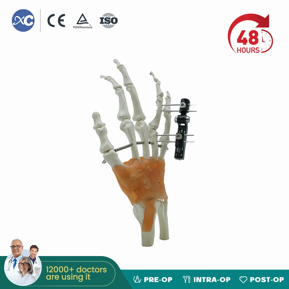 High Quality Mini Fragment External Fixator Orthopedic Medical Metacarpals External Fixation