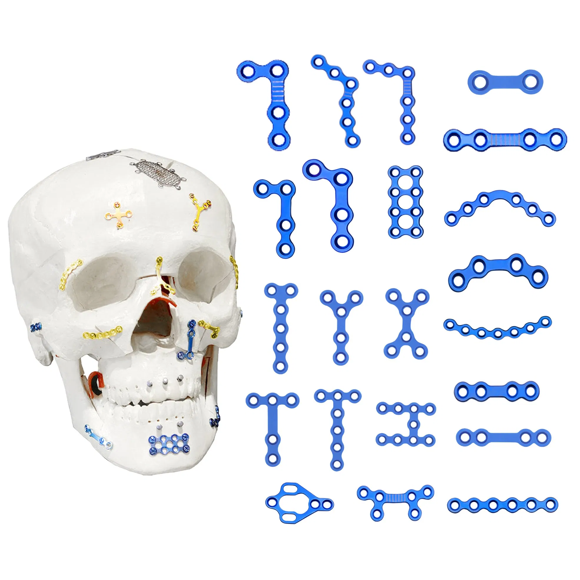 Orthopedic Implant Titanium Alloy Maxillofacial Plates and Screws Locking Plate