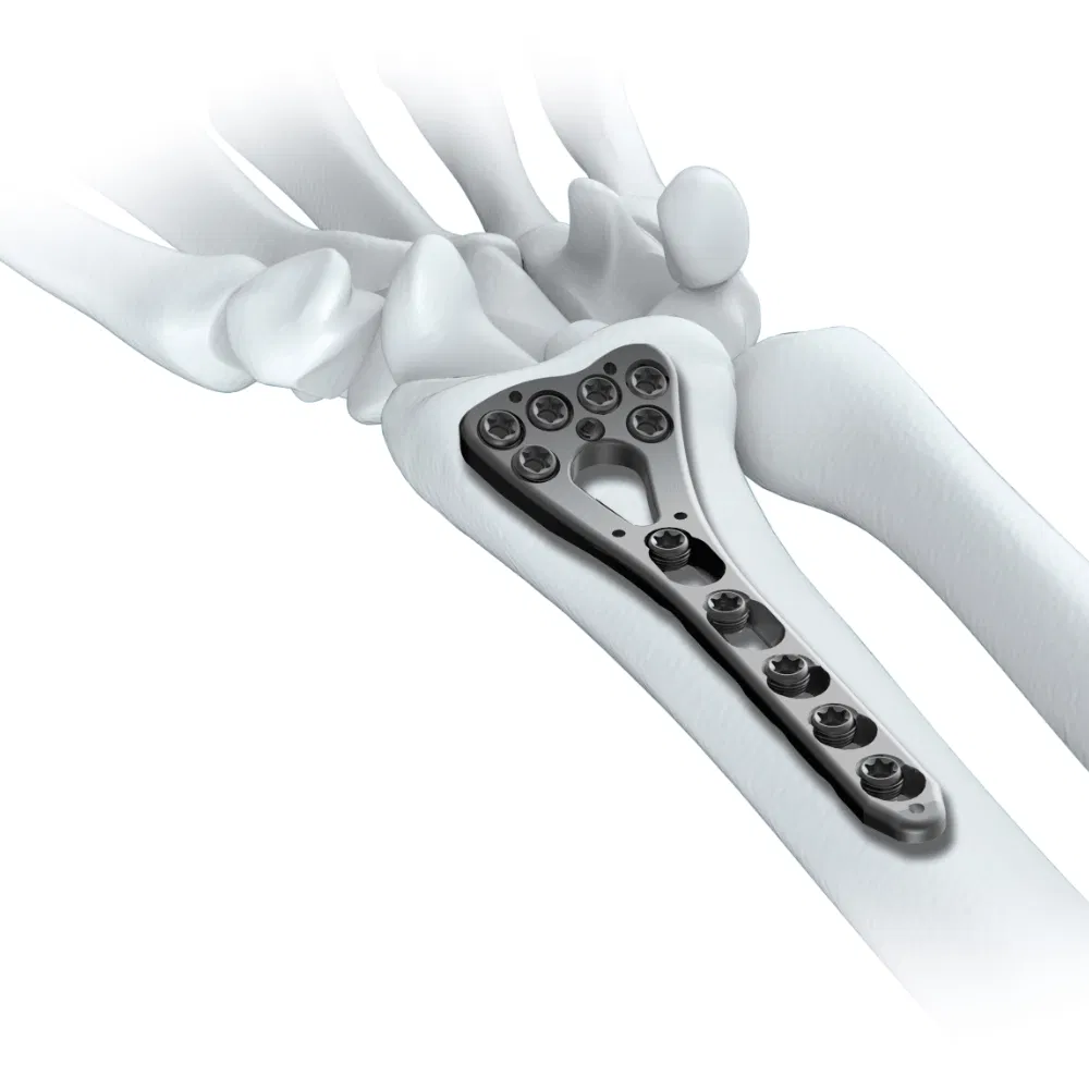 Canwell Variable Angle Radius Locking Plate Orthopaedic Implants Titanium Locking Plate