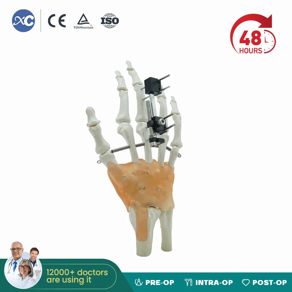 High Quality Mini Fragment External Fixator Orthopedic Medical Metacarpals External Fixation