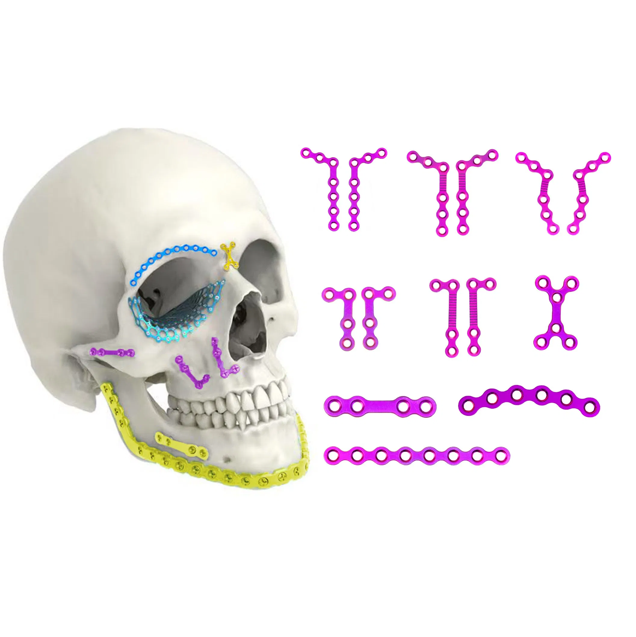 Orthopedic Implant Titanium Alloy Maxillofacial Plates and Screws Locking Plate