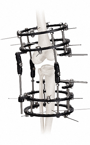 External Fixator for Bone Stabilization, White &amp; Black, Titanium Alloy &amp; Steel