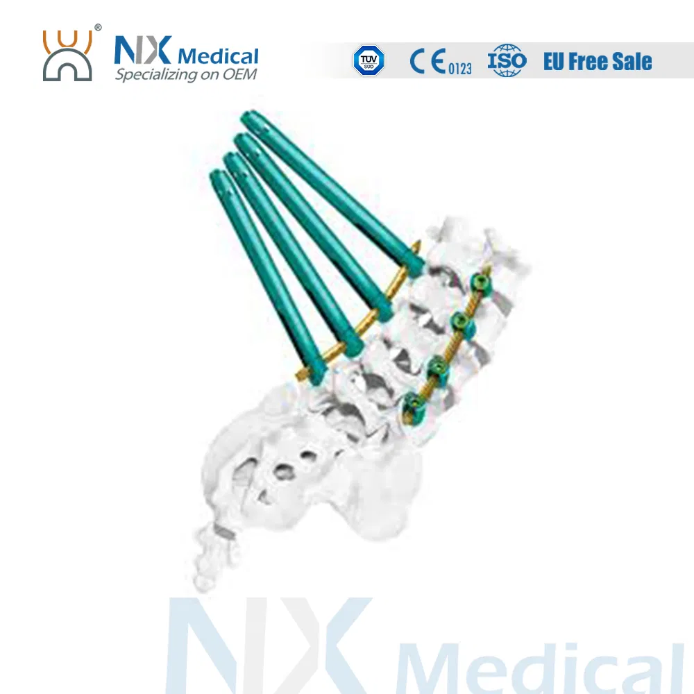 Nx Medical Orthopedic Sf-IV Mis Cannulated Bone Cement Spinal Pedicle Screw 5.5mm