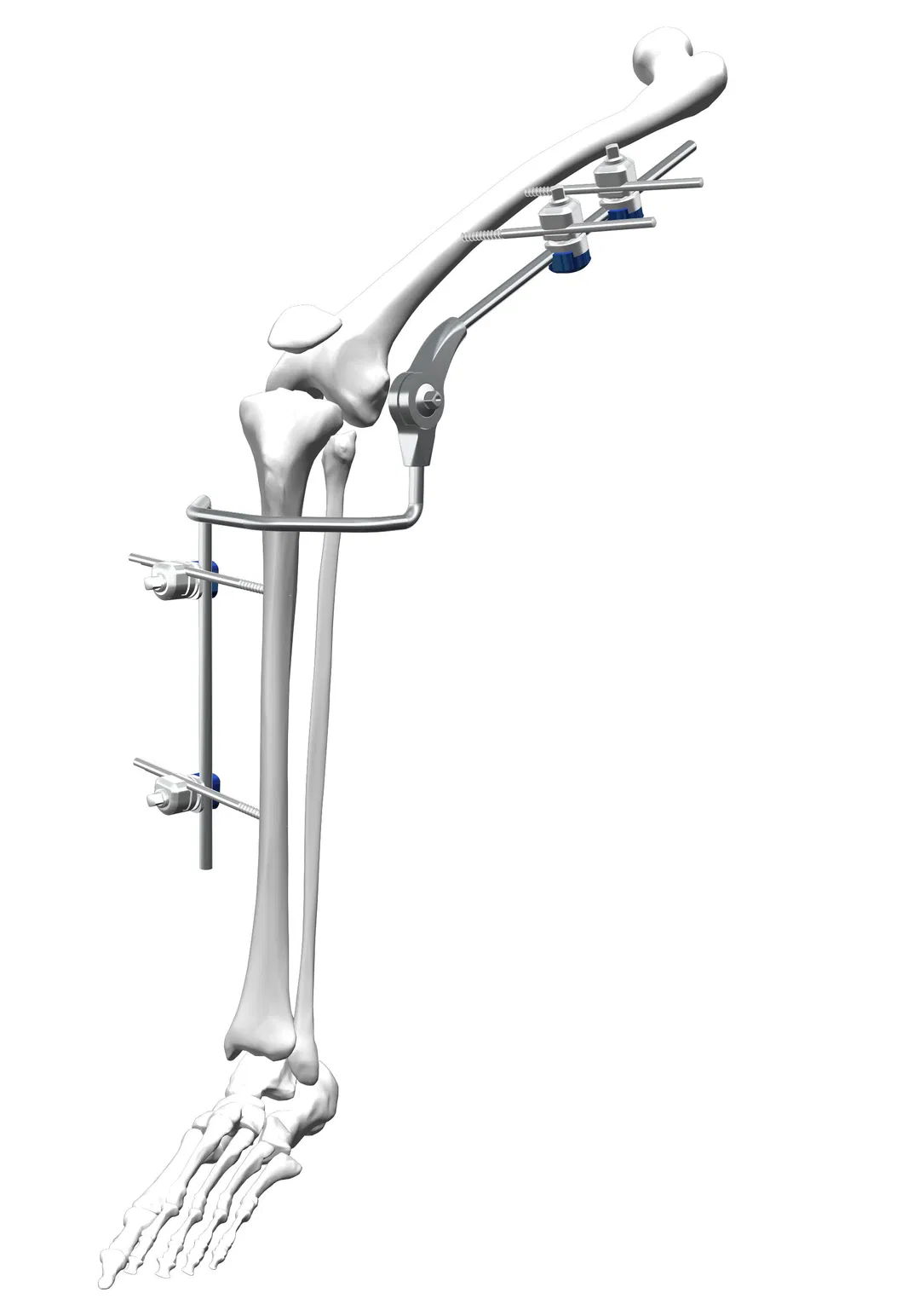 Orthopedic External Fixator