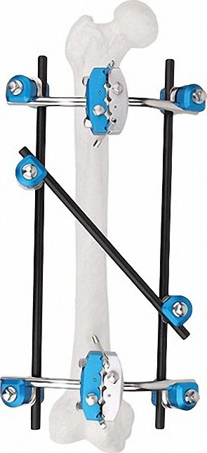 External Fixator for Bone Stabilization, White &amp; Black, Titanium Alloy &amp; Steel