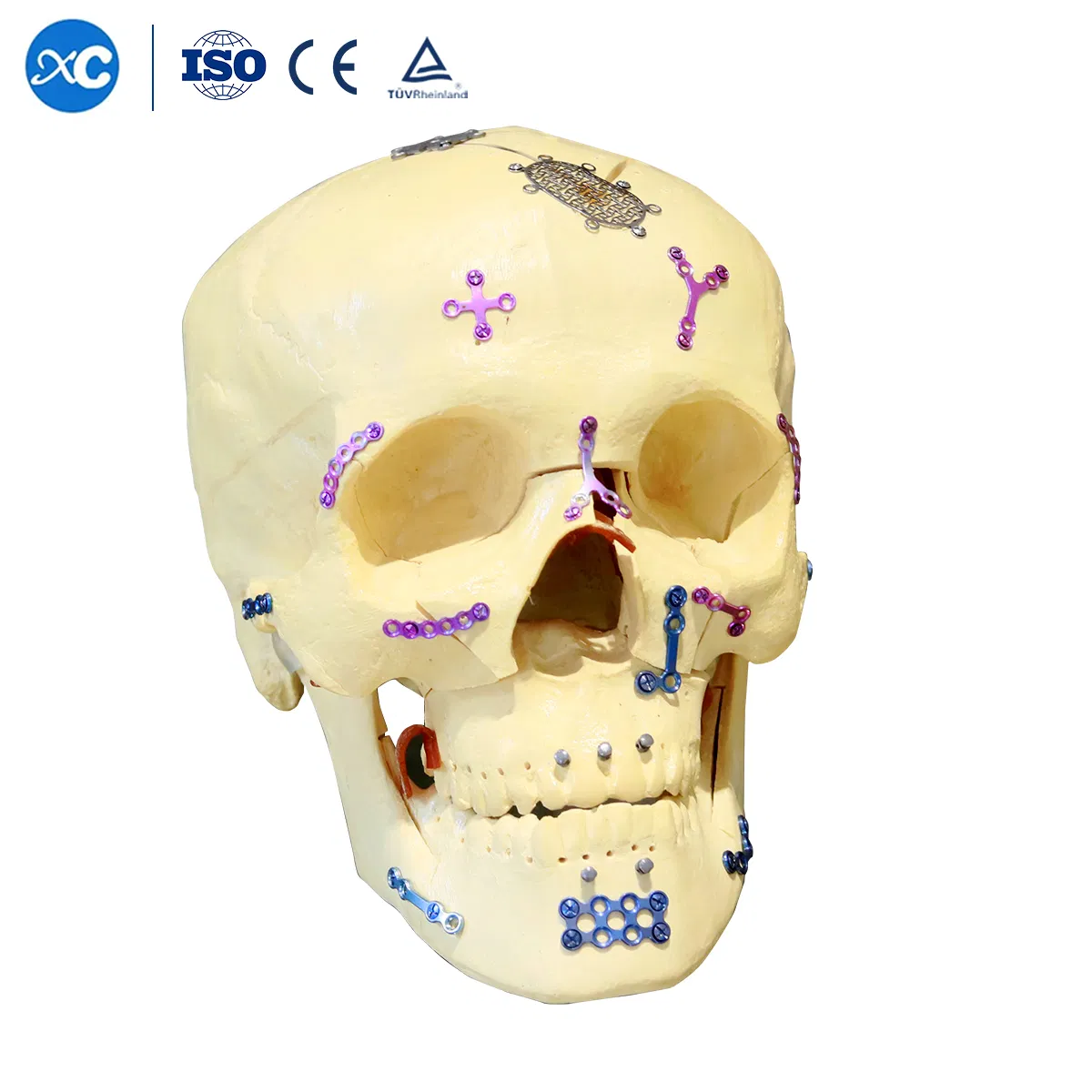 Orthopedic Surgical Neurosurgery Titanium Mesh Cmf Maxillofacial Implants