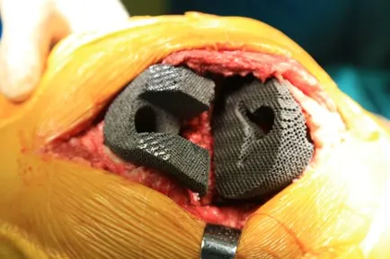 Titanium alloy implant 1