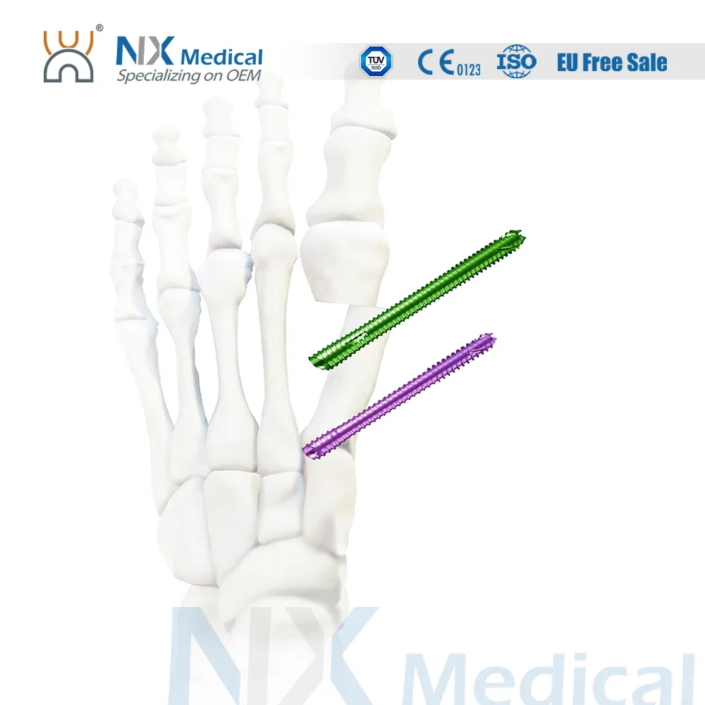 Nx Medical Titanium Cannulated Beleved Bunionectomy Screw Minimum Invasive for Trauma Fixation