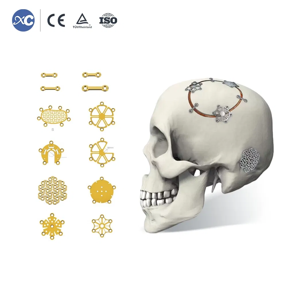 Cmf Titanium Temporal Fossa Interlink Plate for Maxillofacial Reconstruction Strong Stability Implant