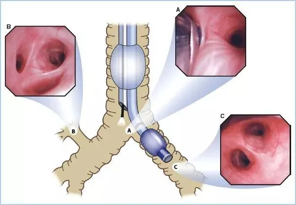 Double Lumen Endotracheal Tube View 1