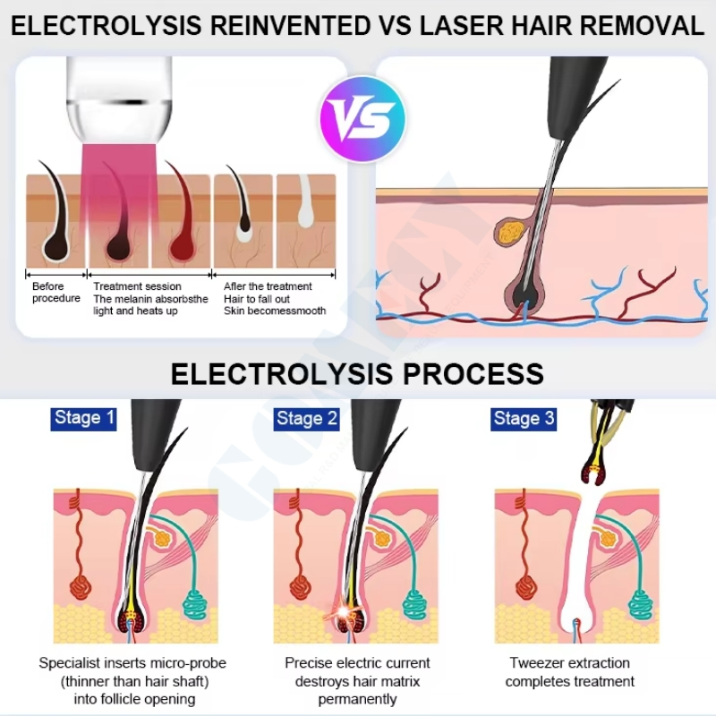Dispositivo de Remoção de Vermelhidão Facial por RF de Alta Frequência e Eletrolise