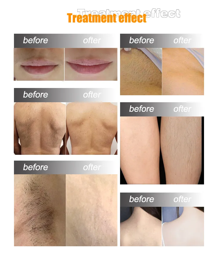 Resultados Antes e Depois do Tratamento de Depilação a Laser