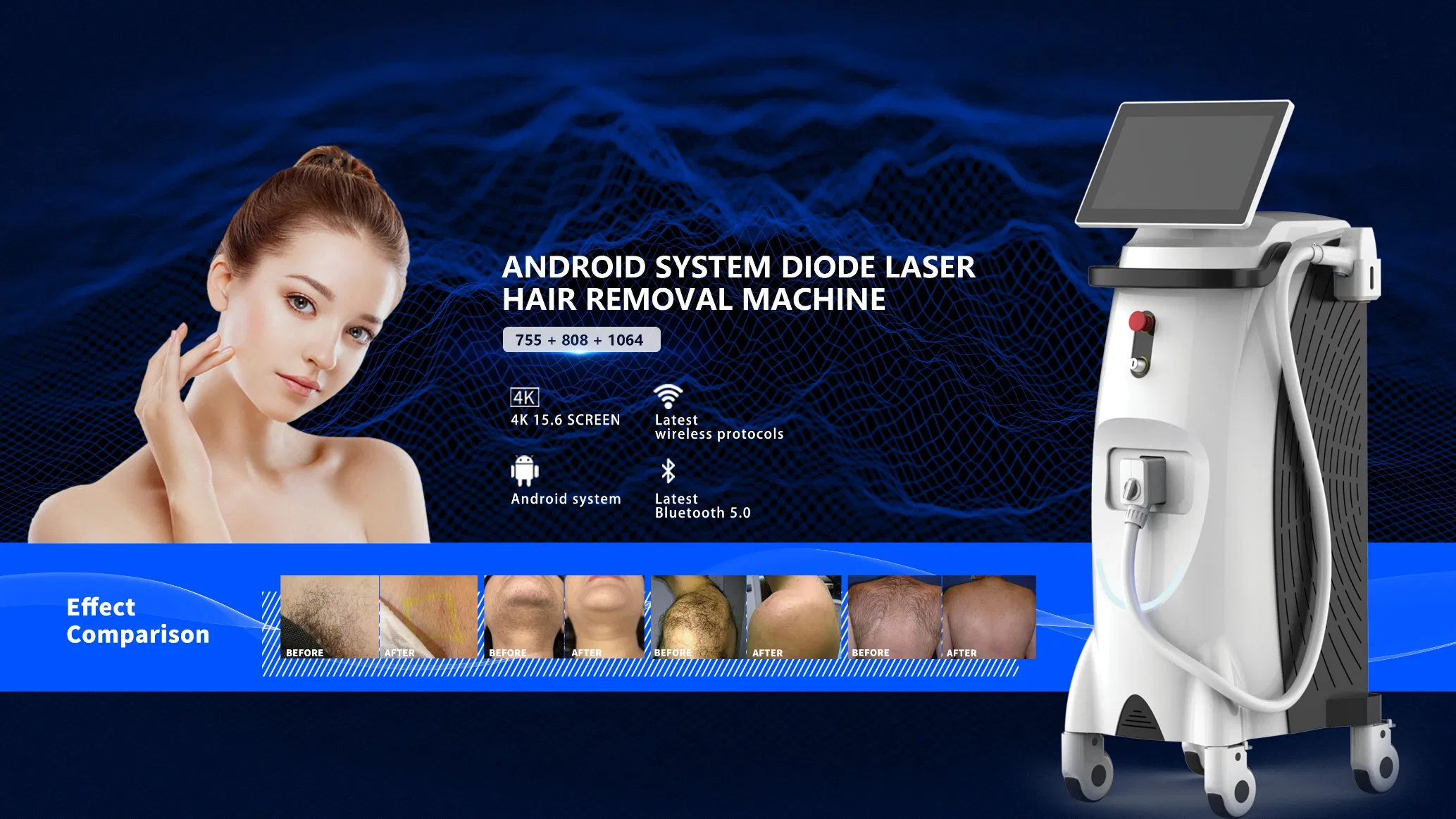 Fornecimento de Fábrica Dispositivo de Remoção de Cabelo de Alta Potência Rejuvenescimento da Pele Clareamento da Pele Cabo de Resfriamento 3wavelenths Dispositivo de Remoção de Cabelo a Laser de Diodo